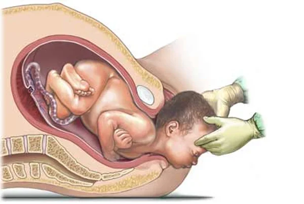 Normal Delivery and Cesarean Section