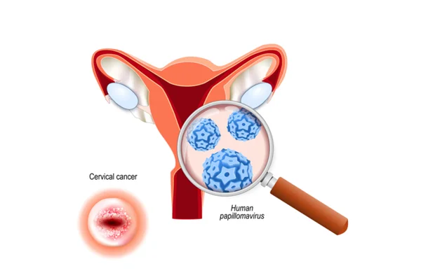 Cervical Cancer Screening And HPV Vaccination